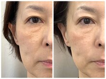 ビクシー(Bixie)/ラミピール＆毛穴洗浄