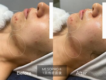オン(on.)/メソプロ施術直後 Before /After