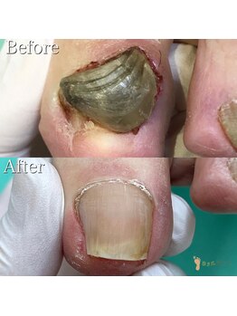 巻き爪補正店 越谷店/変形爪補正