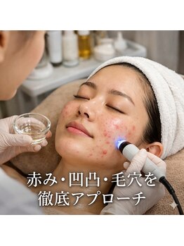 アプロ(Aphro)/ニキビ徹底ケア