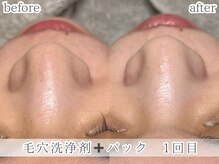 ミック(Mecc)/毛穴洗浄剤＋美容液導入＋パック