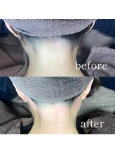 ムート(Mut.)/うなじワックス＋光脱毛。