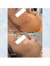 ルシェリア(Le cherien)/5ヶ月before→after