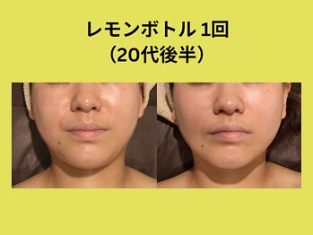 アユアランリンク 錦糸町店/レモンボトル1回