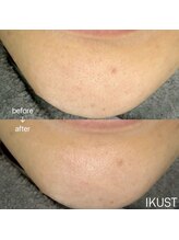 イクスト 吉祥寺(IKUST)/【フェイシャルワックス/脱毛】