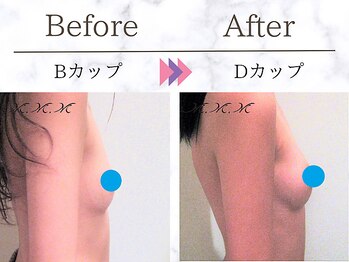メディカルサロン エム エム エム 銀座プレミアムサロン(M.M.M.)/【バストアップ例】 B→Dカップ