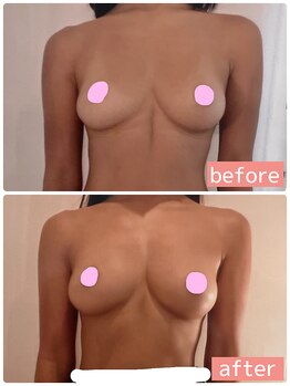 アイン 銀座(Ain)/バストアップ例　４