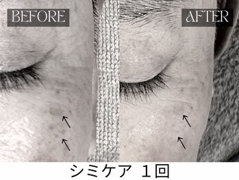 スキンジム(SKIN GYM)/施術は数分◎ダウンタイム無し◎