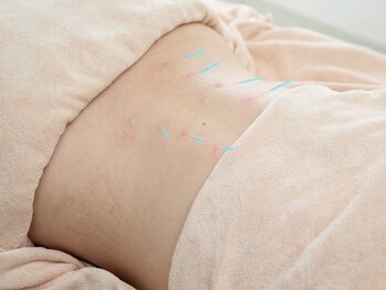 本厚木鍼灸整骨院の写真/《国家資格保持者が施術》身体の疲れを感じている方に◎本格鍼灸で全身の血液を促し、バランスを整えます♪