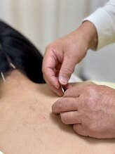 番町もくの木鍼灸院/鍼　肩部施術