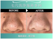 メンズビービー 福井高柳店(MEN'S BB)/毛穴洗浄施術事例