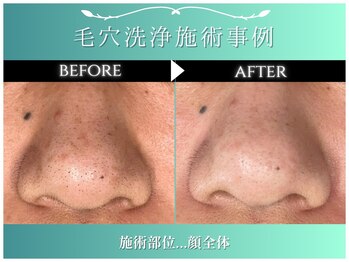 メンズビービー 福井高柳店(MEN'S BB)/毛穴洗浄施術事例