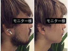 グレイス 久留米店(GRACE)/ワックス脱毛＋光脱毛の効果★