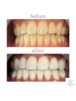 ホワイトニングショップ 長野店/フリーパスコース終了時