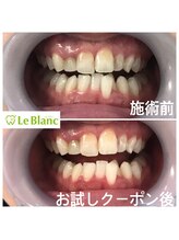 ルブラン 奈良店(Le Blanc)/歯を白くする以外でも