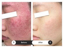 リジュ(Reje)/赤みケア