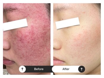 リジュ(Reje)/赤みケア