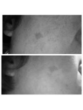 リベルテ(Liberte)/最強プラズマシミケア