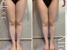 ビノスビューティー(vinos.beauty)/症例写真　下半身痩身1回