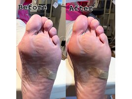 フット角質ケア