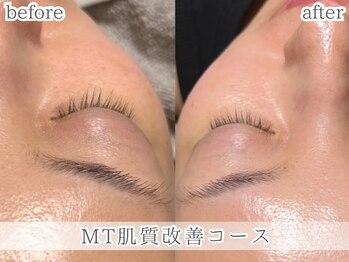 ミック(Mecc)/MTメタトロン肌質改善コース60分