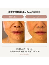 リサプリ(Re: Supple)/肌密度UP! 肌のヒアルロン酸復活