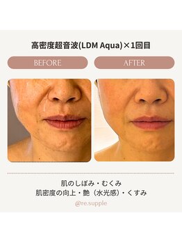 リサプリ(Re: Supple)/肌密度UP! 肌のヒアルロン酸復活