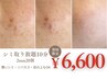 【シミ集中ケア】10分間取り放題◎気になる部分を思う存分 ¥6,000