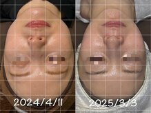 ミヨン(Miyong)の雰囲気（自分ではなかなか改善できないたるみケア/フェイスライン・小顔）