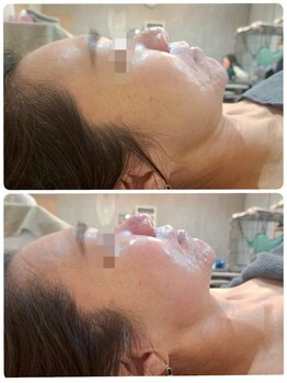 ケンビラク(Kenbiraku 健美楽)/ハイドラプラズマ　シミイレ-サ-