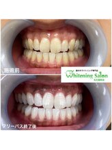 ホワイトニングサロン 名古屋駅店/【ホワイトニング施術例】