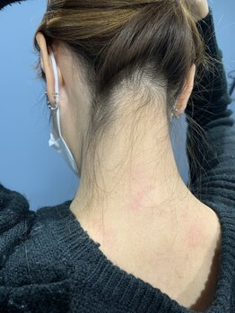 しん整骨院/うなじ脱毛