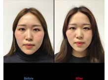 整体カワハラ(KAWAHARA)/小顔整体2回目ビフォーアフター