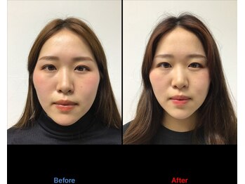 整体カワハラ(KAWAHARA)/小顔整体2回目ビフォーアフター