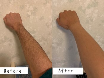 セルフメイド 高崎店(SELFMADE)/ウデ脱毛6回