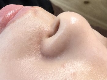 ルポ(repos)の写真/【毛穴レス陶器肌に♪】お悩みに合わせてぴったりのケアをご提案♪毛穴角質ケア/肌トーン・キメUPに◎