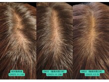 やなけん 亀戸店/分け目から頭皮が目立つ