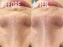 煌(kirameki)/毛穴洗浄/水素ハイドロ