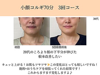 ペルク(perk)/20代の時より顔の下半分が伸びた