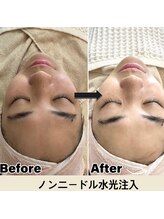 マヴィ 香里園店(MavY.)/最先端美容！針なし水光注入