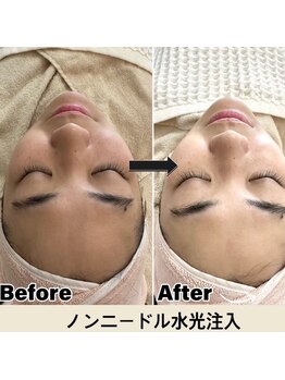 マヴィ 香里園店(MavY.)/最先端美容!針なし水光注入