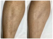 クリア 尾張旭店(Clear)/【Clear脱毛ビフォーアフター】