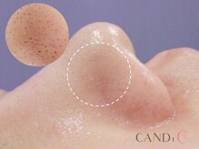 キャンディ 難波心斎橋店(CANDi)/ハイドラピーリング/黒ずみ毛穴