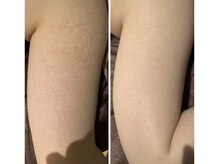 ルアナアイナ(Luana Aina)/ハーブピーリングで二の腕ケア