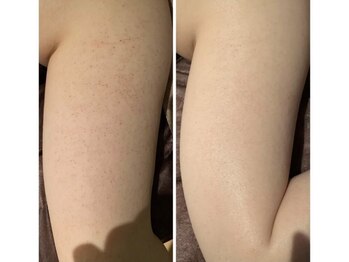 ルアナアイナ(Luana Aina)/ハーブピーリングで二の腕ケア