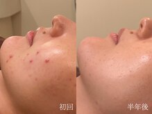 ウォーム(warm)/肌質改善専門店warm/ニキビケア