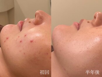 ウォーム(warm)/肌質改善専門店warm/ニキビケア