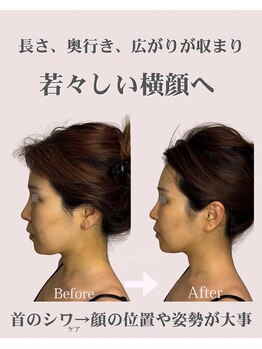 アンジェリカ(Angelica)/若々しさは立体感/首のシワケア