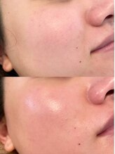 ユフラ(Juhla)/韓国式ハーブピーリング