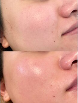 ユフラ(Juhla)/韓国式ハーブピーリング